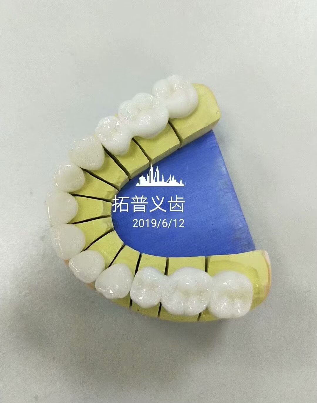 High Esthetics Zirconia Dental Lab Crowns Bridge With Layered Porcelain